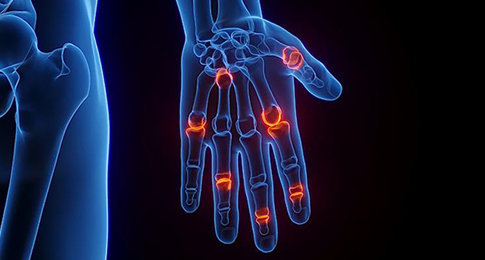 ACR Guidelines for Managing RA